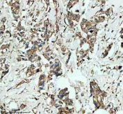 Immunohistochemical staining of GSTK1 using anti-GSTK1 antibody. GSTK1 was detected in a paraffin-embedded section of human breast cancer tissue. Heat mediated antigen retrieval was performed in EDTA buffer (pH 8.0, epitope retrieval solution). The tissue section was blocked with 10% goat serum. The tissue section was then incubated with 2 ug/ml rabbit anti-GSTK1 antibody overnight at 4oC. Peroxidase Conjugated Goat Anti-rabbit IgG was used as secondary antibody and incubated for 30 minutes at 37oC. The tissue section was developed using an HRP secondary and DAB substrate.