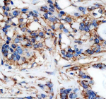 Immunohistochemical staining of HRD1/SYVN1 using anti-SYVN1 antibody. SYVN1 was detected in a paraffin-embedded section of human pancreas cancer tissue. Heat mediated antigen retrieval was performed in EDTA buffer (pH 8.0, epitope retrieval solution). The tissue section was blocked with 10% goat serum. The tissue section was then incubated with 1: 50 rabbit anti-SYVN1 antibody overnight at 4oC. Peroxidase Conjugated Goat Anti-rabbit IgG was used as secondary antibody and incubated for 30 minutes at 37oC. The tissue section was developed using an HRP secondary and DAB substrate.