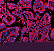 Immunofluorescent staining of NSDHL using anti-NSDHL antibody (red). NSDHL was detected in a paraffin-embedded section of human lung cancer tissue. Heat mediated antigen retrieval was performed in EDTA buffer (pH 8.0, epitope retrieval solution). The tissue section was blocked with 10% goat serum. The tissue section was then incubated with 5 ug/ml rabbit anti-NSDHL antibody overnight at 4oC. Cy3 Conjugated Goat Anti-Rabbit IgG was used as secondary antibody at 1:500 dilution and incubated for 30 minutes at 37oC. The section was counterstained with DAPI nuclear stain (blue). Visualize using a fluorescence microscope and filter sets appropriate for the label used.