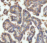 Immunohistochemical staining of NSDHL using anti-NSDHL antibody. NSDHL was detected in a paraffin-embedded section of human lung cancer tissue. Heat mediated antigen retrieval was performed in EDTA buffer (pH 8.0, epitope retrieval solution). The tissue section was blocked with 10% goat serum. The tissue section was then incubated with 2 ug/ml rabbit anti-NSDHL antibody overnight at 4oC. Peroxidase Conjugated Goat Anti-rabbit IgG was used as secondary antibody and incubated for 30 minutes at 37oC. The tissue section was developed using an HRP secondary and DAB substrate.