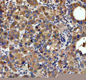 Immunohistochemical staining of NSDHL using anti-NSDHL antibody. NSDHL was detected in a paraffin-embedded section of human liver cancer tissue. Heat mediated antigen retrieval was performed in EDTA buffer (pH 8.0, epitope retrieval solution). The tissue section was blocked with 10% goat serum. The tissue section was then incubated with 2 ug/ml rabbit anti-NSDHL antibody overnight at 4oC. Peroxidase Conjugated Goat Anti-rabbit IgG was used as secondary antibody and incubated for 30 minutes at 37oC. The tissue section was developed using an HRP secondary and DAB substrate.