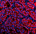 Immunofluorescent staining of NSDHL using anti-NSDHL antibody (red). NSDHL was detected in a paraffin-embedded section of human liver cancer tissue. Heat mediated antigen retrieval was performed in EDTA buffer (pH 8.0, epitope retrieval solution). The tissue section was blocked with 10% goat serum. The tissue section was then incubated with 5 ug/ml rabbit anti-NSDHL antibody overnight at 4oC. Cy3 Conjugated Goat Anti-Rabbit IgG was used as secondary antibody at 1:500 dilution and incubated for 30 minutes at 37oC. The section was counterstained with DAPI nuclear stain (blue). Visualize using a fluorescence microscope and filter sets appropriate for the label used.