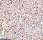 Immunohistochemical staining of SILV/PMEL using anti-PMEL antibody. SILV/PMEL was detected in a paraffin-embedded section of human melanoma tissue. Heat mediated antigen retrieval was performed in EDTA buffer (pH 8.0, epitope retrieval solution). The tissue section was blocked with 10% goat serum. The tissue section was then incubated with 2 ug/ml rabbit anti-PMEL antibody overnight at 4oC. Peroxidase Conjugated Goat Anti-rabbit IgG was used as secondary antibody and incubated for 30 minutes at 37oC. The tissue section was developed using an HRP secondary and DAB substrate.