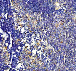 Immunohistochemical staining of PUF60 using anti-PUF60 antibody. PUF60 was detected in a paraffin-embedded section of human breast cancer tissue. Heat mediated antigen retrieval was performed in EDTA buffer (pH 8.0, epitope retrieval solution). The tissue section was blocked with 10% goat serum. The tissue section was then incubated with 2 ug/ml rabbit anti-PUF60 antibody overnight at 4oC. Peroxidase Conjugated Goat Anti-rabbit IgG was used as secondary antibody and incubated for 30 minutes at 37oC. The tissue section was developed using an HRP secondary and DAB substrate.
