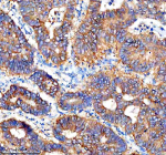 Immunohistochemical staining of Cathepsin F/CTSF using anti-CTSF antibody. Cathepsin F/CTSF was detected in a paraffin-embedded section of human stomach cancer tissue. Heat mediated antigen retrieval was performed in EDTA buffer (pH 8.0, epitope retrieval solution). The tissue section was blocked with 10% goat serum. The tissue section was then incubated with 2 ug/ml rabbit anti-CTSF antibody overnight at 4oC. Peroxidase Conjugated Goat Anti-rabbit IgG was used as secondary antibody and incubated for 30 minutes at 37oC. The tissue section was developed using an HRP secondary and DAB substrate.