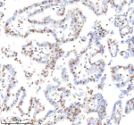 Immunohistochemical staining of Histone H3 using anti-Histone H3 (acetyl K9) antibody. Histone H3 (acetyl K9) was detected in a paraffin-embedded section of human lung cancer tissue. Heat mediated antigen retrieval was performed in EDTA buffer (pH 8.0, epitope retrieval solution). The tissue section was blocked with 10% goat serum. The tissue section was then incubated with 1:50 rabbit anti-Histone H3 (acetyl K9) antibody overnight at 4oC. Peroxidase Conjugated Goat Anti-rabbit IgG was used as secondary antibody and incubated for 30 minutes at 37oC. The tissue section was developed using an HRP secondary and DAB substrate.