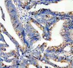 Immunohistochemical staining of SPINK4 using anti-SPINK4 antibody. SPINK4 was detected in a paraffin-embedded section of human colon cancer tissue. Heat mediated antigen retrieval was performed in EDTA buffer (pH 8.0, epitope retrieval solution). The tissue section was blocked with 10% goat serum. The tissue section was then incubated with 2 ug/ml rabbit anti-SPINK4 antibody overnight at 4oC. Peroxidase Conjugated Goat Anti-rabbit IgG was used as secondary antibody and incubated for 30 minutes at 37oC. The tissue section was developed using an HRP secondary and DAB substrate.