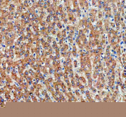 Immunohistochemical staining of PGAM5 using anti-PGAM5 antibody. PGAM5 was detected in a paraffin-embedded section of human liver cancer tissue. Heat mediated antigen retrieval was performed in EDTA buffer (pH 8.0, epitope retrieval solution). The tissue section was blocked with 10% goat serum. The tissue section was then incubated with 1:100 rabbit anti-PGAM5 antibody overnight at 4oC. Peroxidase Conjugated Goat Anti-rabbit IgG was used as secondary antibody and incubated for 30 minutes at 37oC. The tissue section was developed using an HRP secondary and DAB substrate.