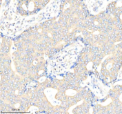 Immunohistochemical staining of Biglycan/BGN using anti-BGN antibody. Biglycan/BGN was detected in a paraffin-embedded section of human breast cancer tissue. Heat mediated antigen retrieval was performed in EDTA buffer (pH 8.0, epitope retrieval solution). The tissue section was blocked with 10% goat serum. The tissue section was then incubated with 2 ug/ml rabbit anti-BGN antibody overnight at 4oC. Peroxidase Conjugated Goat Anti-rabbit IgG was used as secondary antibody and incubated for 30 minutes at 37oC. The tissue section was developed using an HRP secondary and DAB substrate.