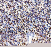 Immunohistochemical staining of TYRP1 using anti-TYRP1 antibody. TYRP1 was detected in a paraffin-embedded section of human melanoma tissue. Heat mediated antigen retrieval was performed in EDTA buffer (pH 8.0, epitope retrieval solution). The tissue section was blocked with 10% goat serum. The tissue section was then incubated with 2 ug/ml rabbit anti-TYRP1 antibody overnight at 4oC. Peroxidase Conjugated Goat Anti-rabbit IgG was used as secondary antibody and incubated for 30 minutes at 37oC. The tissue section was developed using an HRP secondary and DAB substrate.
