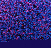 Immunofluorescent staining of TYRP1 using anti-TYRP1 antibody (red). TYRP1 was detected in a paraffin-embedded section of human melanoma tissue. Heat mediated antigen retrieval was performed in EDTA buffer (pH 8.0, epitope retrieval solution). The tissue section was blocked with 10% goat serum. The tissue section was then incubated with 5 ug/ml rabbit anti-TYRP1 antibody overnight at 4oC. Cy3 Conjugated Goat Anti-Rabbit IgG was used as secondary antibody at 1:500 dilution and incubated for 30 minutes at 37oC. The section was counterstained with DAPI nuclear stain (blue). Visualize using a fluorescence microscope and filter sets appropriate for the label used.
