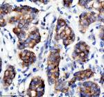 Immunohistochemical staining of SESN2 using anti-SESN2 antibody. SESN2 was detected in a paraffin-embedded section of human breast cancer tissue. Heat mediated antigen retrieval was performed in EDTA buffer (pH 8.0, epitope retrieval solution). The tissue section was blocked with 10% goat serum. The tissue section was then incubated with 2 ug/ml rabbit anti-SESN2 antibody overnight at 4oC. Peroxidase Conjugated Goat Anti-rabbit IgG was used as secondary antibody and incubated for 30 minutes at 37oC. The tissue section was developed using an HRP secondary and DAB substrate.