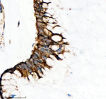 Immunohistochemical staining of SESN2 using anti-SESN2 antibody. SESN2 was detected in a paraffin-embedded section of human colon cancer tissue. Heat mediated antigen retrieval was performed in EDTA buffer (pH 8.0, epitope retrieval solution). The tissue section was blocked with 10% goat serum. The tissue section was then incubated with 2 ug/ml rabbit anti-SESN2 antibody overnight at 4oC. Peroxidase Conjugated Goat Anti-rabbit IgG was used as secondary antibody and incubated for 30 minutes at 37oC. The tissue section was developed using an HRP secondary and DAB substrate.