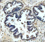 Immunohistochemical staining of SRA1 using anti-SRA1 antibody. SRA1 was detected in a paraffin-embedded section of human ovarian cancer tissue. Heat mediated antigen retrieval was performed in EDTA buffer (pH 8.0, epitope retrieval solution). The tissue section was blocked with 10% goat serum. The tissue section was then incubated with 1: 200 rabbit anti-SRA1 antibody overnight at 4oC. Peroxidase Conjugated Goat Anti-rabbit IgG was used as secondary antibody and incubated for 30 minutes at 37oC. The tissue section was developed using an HRP secondary and DAB substrate.