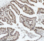 Immunohistochemical staining of DIS3 using anti-DIS3 antibody. DIS3 was detected in a paraffin-embedded section of human colon cancer tissue. Heat mediated antigen retrieval was performed in EDTA buffer (pH 8.0, epitope retrieval solution). The tissue section was blocked with 10% goat serum. The tissue section was then incubated with 2 ug/ml rabbit anti-DIS3 antibody overnight at 4oC. Peroxidase Conjugated Goat Anti-rabbit IgG was used as secondary antibody and incubated for 30 minutes at 37oC. The tissue section was developed using an HRP secondary and DAB substrate.