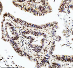 Immunohistochemical staining of DIS3 using anti-DIS3 antibody. DIS3 was detected in a paraffin-embedded section of human colon cancer tissue. Heat mediated antigen retrieval was performed in EDTA buffer (pH 8.0, epitope retrieval solution). The tissue section was blocked with 10% goat serum. The tissue section was then incubated with 2 ug/ml rabbit anti-DIS3 antibody overnight at 4oC. Peroxidase Conjugated Goat Anti-rabbit IgG was used as secondary antibody and incubated for 30 minutes at 37oC. The tissue section was developed using an HRP secondary and DAB substrate.