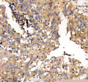 Immunohistochemical staining of TWSG1 using anti-TWSG1 antibody. TWSG1 was detected in a paraffin-embedded section of human bladder cancer tissue. Heat mediated antigen retrieval was performed in EDTA buffer (pH 8.0, epitope retrieval solution). The tissue section was blocked with 10% goat serum. The tissue section was then incubated with 2 ug/ml rabbit anti-TWSG1 antibody overnight at 4oC. Peroxidase Conjugated Goat Anti-rabbit IgG was used as secondary antibody and incubated for 30 minutes at 37oC. The tissue section was developed using an HRP secondary and DAB substrate.