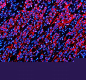 Immunofluorescent staining of TWSG1 using anti-TWSG1 antibody (red). TWSG1 was detected in a paraffin-embedded section of human bladder cancer tissue. Heat mediated antigen retrieval was performed in EDTA buffer (pH 8.0, epitope retrieval solution). The tissue section was blocked with 10% goat serum. The tissue section was then incubated with 5 ug/ml rabbit anti-TWSG1 antibody overnight at 4oC. Cy3 Conjugated Goat Anti-Rabbit IgG was used as secondary antibody at 1:500 dilution and incubated for 30 minutes at 37oC. The section was counterstained with DAPI nuclear stain (blue). Visualize using a fluorescence microscope and filter sets appropriate for the label used.