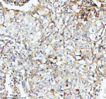 Immunohistochemical staining of SBK1 using anti-SBK1 antibody. SBK1 was detected in a paraffin-embedded section of human lung cancer tissue. Heat mediated antigen retrieval was performed in EDTA buffer (pH 8.0, epitope retrieval solution). The tissue section was blocked with 10% goat serum. The tissue section was then incubated with 2 ug/ml rabbit anti-SBK1 antibody overnight at 4oC. Peroxidase Conjugated Goat Anti-rabbit IgG was used as secondary antibody and incubated for 30 minutes at 37oC. The tissue section was developed using an HRP secondary and DAB substrate.