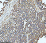 Immunohistochemical staining of SBK1 using anti-SBK1 antibody. SBK1 was detected in a paraffin-embedded section of human ovarian cancer tissue. Heat mediated antigen retrieval was performed in EDTA buffer (pH 8.0, epitope retrieval solution). The tissue section was blocked with 10% goat serum. The tissue section was then incubated with 2 ug/ml rabbit anti-SBK1 antibody overnight at 4oC. Peroxidase Conjugated Goat Anti-rabbit IgG was used as secondary antibody and incubated for 30 minutes at 37oC. The tissue section was developed using an HRP secondary and DAB substrate.