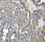 Immunohistochemical staining of SBK1 using anti-SBK1 antibody. SBK1 was detected in a paraffin-embedded section of human ovarian cancer tissue. Heat mediated antigen retrieval was performed in EDTA buffer (pH 8.0, epitope retrieval solution). The tissue section was blocked with 10% goat serum. The tissue section was then incubated with 2 ug/ml rabbit anti-SBK1 antibody overnight at 4oC. Peroxidase Conjugated Goat Anti-rabbit IgG was used as secondary antibody and incubated for 30 minutes at 37oC. The tissue section was developed using an HRP secondary and DAB substrate.