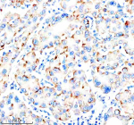 Immunohistochemical staining of NUDT7 using anti-NUDT7 antibody. NUDT7 was detected in a paraffin-embedded section of human liver cancer tissue. Heat mediated antigen retrieval was performed in EDTA buffer (pH 8.0, epitope retrieval solution). The tissue section was blocked with 10% goat serum. The tissue section was then incubated with 2 ug/ml rabbit anti-NUDT7 antibody overnight at 4oC. Peroxidase Conjugated Goat Anti-rabbit IgG was used as secondary antibody and incubated for 30 minutes at 37oC. The tissue section was developed using an HRP secondary and DAB substrate.