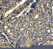 Immunohistochemical staining of IFT20 using anti-IFT20 antibody. IFT20 was detected in a paraffin-embedded section of human colon cancer tissue. Heat mediated antigen retrieval was performed in EDTA buffer (pH 8.0, epitope retrieval solution). The tissue section was blocked with 10% goat serum. The tissue section was then incubated with 2 ug/ml rabbit anti-IFT20 antibody overnight at 4oC. Peroxidase Conjugated Goat Anti-rabbit IgG was used as secondary antibody and incubated for 30 minutes at 37oC. The tissue section was developed using an HRP secondary and DAB substrate.