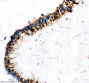 Immunohistochemical staining of IFT20 using anti-IFT20 antibody. IFT20 was detected in a paraffin-embedded section of human colon cancer tissue. Heat mediated antigen retrieval was performed in EDTA buffer (pH 8.0, epitope retrieval solution). The tissue section was blocked with 10% goat serum. The tissue section was then incubated with 2 ug/ml rabbit anti-IFT20 antibody overnight at 4oC. Peroxidase Conjugated Goat Anti-rabbit IgG was used as secondary antibody and incubated for 30 minutes at 37oC. The tissue section was developed using an HRP secondary and DAB substrate.