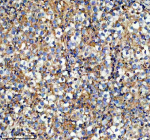 Immunohistochemical staining of IFT20 using anti-IFT20 antibody. IFT20 was detected in a paraffin-embedded section of human testis cancer tissue. Heat mediated antigen retrieval was performed in EDTA buffer (pH 8.0, epitope retrieval solution). The tissue section was blocked with 10% goat serum. The tissue section was then incubated with 2 ug/ml rabbit anti-IFT20 antibody overnight at 4oC. Peroxidase Conjugated Goat Anti-rabbit IgG was used as secondary antibody and incubated for 30 minutes at 37oC. The tissue section was developed using an HRP secondary and DAB substrate.