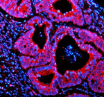 Immunofluorescent staining of IFT20 using anti-IFT20 antibody (red). IFT20 was detected in a paraffin-embedded section of human colon cancer tissue. Heat mediated antigen retrieval was performed in EDTA buffer (pH 8.0, epitope retrieval solution). The tissue section was blocked with 10% goat serum. The tissue section was then incubated with 5 ug/ml rabbit anti-IFT20 antibody overnight at 4oC. Cy3 Conjugated Goat Anti-Rabbit IgG was used as secondary antibody at 1:500 dilution and incubated for 30 minutes at 37oC. The section was counterstained with DAPI nuclear stain (blue). Visualize using a fluorescence microscope and filter sets appropriate for the label used.