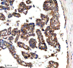 Immunohistochemical staining of SRBD1 using anti-SRBD1 antibody. SRBD1 was detected in a paraffin-embedded section of human lung adenocarcinoma tissue. Heat mediated antigen retrieval was performed in EDTA buffer (pH 8.0, epitope retrieval solution). The tissue section was blocked with 10% goat serum. The tissue section was then incubated with 2 ug/ml rabbit anti-SRBD1 antibody overnight at 4oC. Peroxidase Conjugated Goat Anti-rabbit IgG was used as secondary antibody and incubated for 30 minutes at 37oC. The tissue section was developed using an HRP secondary and DAB substrate.