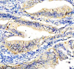Immunohistochemical staining of CYP2W1 using anti-CYP2W1 antibody. CYP2W1 was detected in a paraffin-embedded section of human colon cancer tissue. Heat mediated antigen retrieval was performed in EDTA buffer (pH 8.0, epitope retrieval solution). The tissue section was blocked with 10% goat serum. The tissue section was then incubated with 2 ug/ml rabbit anti-CYP2W1 antibody overnight at 4oC. Peroxidase Conjugated Goat Anti-rabbit IgG was used as secondary antibody and incubated for 30 minutes at 37oC. The tissue section was developed using an HRP secondary and DAB substrate.