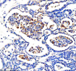 Immunohistochemical staining of CYP2W1 using anti-CYP2W1 antibody. CYP2W1 was detected in a paraffin-embedded section of human ovarian cancer tissue. Heat mediated antigen retrieval was performed in EDTA buffer (pH 8.0, epitope retrieval solution). The tissue section was blocked with 10% goat serum. The tissue section was then incubated with 2 ug/ml rabbit anti-CYP2W1 antibody overnight at 4oC. Peroxidase Conjugated Goat Anti-rabbit IgG was used as secondary antibody and incubated for 30 minutes at 37oC. The tissue section was developed using an HRP secondary and DAB substrate.