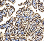 Immunohistochemical staining of RASSF8 using anti-RASSF8 antibody. RASSF8 was detected in a paraffin-embedded section of human ovarian cancer tissue. Heat mediated antigen retrieval was performed in EDTA buffer (pH 8.0, epitope retrieval solution). The tissue section was blocked with 10% goat serum. The tissue section was then incubated with 2 ug/ml rabbit anti-RASSF8 antibody overnight at 4oC. Peroxidase Conjugated Goat Anti-rabbit IgG was used as secondary antibody and incubated for 30 minutes at 37oC. The tissue section was developed using an HRP secondary and DAB substrate.