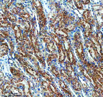 Immunohistochemical staining of ENTPD5 using anti-ENTPD5 antibody. ENTPD5 was detected in a paraffin-embedded section of human lung cancer tissue. Heat mediated antigen retrieval was performed in EDTA buffer (pH 8.0, epitope retrieval solution). The tissue section was blocked with 10% goat serum. The tissue section was then incubated with 2 ug/ml rabbit anti-ENTPD5 antibody overnight at 4oC. Peroxidase Conjugated Goat Anti-rabbit IgG was used as secondary antibody and incubated for 30 minutes at 37oC. The tissue section was developed using an HRP secondary and DAB substrate.