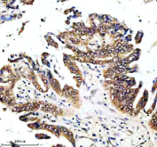 Immunohistochemical staining of ENTPD5 using anti-ENTPD5 antibody. ENTPD5 was detected in a paraffin-embedded section of human lung cancer tissue. Heat mediated antigen retrieval was performed in EDTA buffer (pH 8.0, epitope retrieval solution). The tissue section was blocked with 10% goat serum. The tissue section was then incubated with 2 ug/ml rabbit anti-ENTPD5 antibody overnight at 4oC. Peroxidase Conjugated Goat Anti-rabbit IgG was used as secondary antibody and incubated for 30 minutes at 37oC. The tissue section was developed using an HRP secondary and DAB substrate.