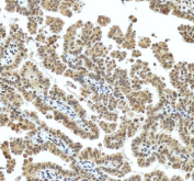 Immunohistochemical staining of MECP2 using anti-MECP2 antibody. MECP2 was detected in a paraffin-embedded section of human ovarian cancer tissue. Heat mediated antigen retrieval was performed in EDTA buffer (pH 8.0, epitope retrieval solution). The tissue section was blocked with 10% goat serum. The tissue section was then incubated with 2 ug/ml rabbit anti-MECP2 antibody overnight at 4oC. Peroxidase Conjugated Goat Anti-rabbit IgG was used as secondary antibody and incubated for 30 minutes at 37oC. The tissue section was developed using an HRP secondary and DAB substrate.