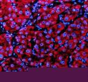 Immunofluorescent staining of PECR using anti-PECR antibody (red). PECR was detected in a paraffin-embedded section of human liver cancer tissue. Heat mediated antigen retrieval was performed in EDTA buffer (pH 8.0, epitope retrieval solution). The tissue section was blocked with 10% goat serum. The tissue section was then incubated with 5 ug/ml rabbit anti-PECR antibody overnight at 4oC. Cy3 Conjugated Goat Anti-Rabbit IgG was used as secondary antibody at 1:500 dilution and incubated for 30 minutes at 37oC. The section was counterstained with DAPI nuclear stain (blue). Visualize using a fluorescence microscope and filter sets appropriate for the label used.