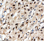 Immunohistochemical staining of SCAF11 using anti-SCAF11 antibody. SCAF11 was detected in a paraffin-embedded section of human bladder cancer tissue. Heat mediated antigen retrieval was performed in EDTA buffer (pH 8.0, epitope retrieval solution). The tissue section was blocked with 10% goat serum. The tissue section was then incubated with 2 ug/ml rabbit anti-SCAF11 antibody overnight at 4oC. Peroxidase Conjugated Goat Anti-rabbit IgG was used as secondary antibody and incubated for 30 minutes at 37oC. The tissue section was developed using an HRP secondary and DAB substrate.