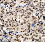 Immunohistochemical staining of SCAF11 using anti-SCAF11 antibody. SCAF11 was detected in a paraffin-embedded section of human cervical cancer tissue. Heat mediated antigen retrieval was performed in EDTA buffer (pH 8.0, epitope retrieval solution). The tissue section was blocked with 10% goat serum. The tissue section was then incubated with 2 ug/ml rabbit anti-SCAF11 antibody overnight at 4oC. Peroxidase Conjugated Goat Anti-rabbit IgG was used as secondary antibody and incubated for 30 minutes at 37oC. The tissue section was developed using an HRP secondary and DAB substrate.