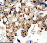 Immunohistochemical staining of SCAF11 using anti-SCAF11 antibody. SCAF11 was detected in a paraffin-embedded section of human lung cancer tissue. Heat mediated antigen retrieval was performed in EDTA buffer (pH 8.0, epitope retrieval solution). The tissue section was blocked with 10% goat serum. The tissue section was then incubated with 2 ug/ml rabbit anti-SCAF11 antibody overnight at 4oC. Peroxidase Conjugated Goat Anti-rabbit IgG was used as secondary antibody and incubated for 30 minutes at 37oC. The tissue section was developed using an HRP secondary and DAB substrate.