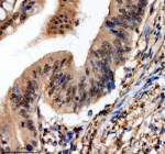Immunohistochemical staining of SCAF11 using anti-SCAF11 antibody. SCAF11 was detected in a paraffin-embedded section of human colon cancer tissue. Heat mediated antigen retrieval was performed in EDTA buffer (pH 8.0, epitope retrieval solution). The tissue section was blocked with 10% goat serum. The tissue section was then incubated with 2 ug/ml rabbit anti-SCAF11 antibody overnight at 4oC. Peroxidase Conjugated Goat Anti-rabbit IgG was used as secondary antibody and incubated for 30 minutes at 37oC. The tissue section was developed using an HRP secondary and DAB substrate.