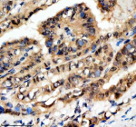 Immunohistochemical staining of SCAF11 using anti-SCAF11 antibody. SCAF11 was detected in a paraffin-embedded section of human thyroid cancer tissue. Heat mediated antigen retrieval was performed in EDTA buffer (pH 8.0, epitope retrieval solution). The tissue section was blocked with 10% goat serum. The tissue section was then incubated with 2 ug/ml rabbit anti-SCAF11 antibody overnight at 4oC. Peroxidase Conjugated Goat Anti-rabbit IgG was used as secondary antibody and incubated for 30 minutes at 37oC. The tissue section was developed using an HRP secondary and DAB substrate.