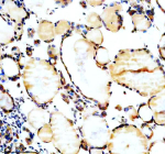 Immunohistochemical staining of SPOCK1 using anti-SPOCK1 antibody. SPOCK1 was detected in a paraffin-embedded section of human thyroid cancer tissue. Heat mediated antigen retrieval was performed in EDTA buffer (pH 8.0, epitope retrieval solution). The tissue section was blocked with 10% goat serum. The tissue section was then incubated with 2 ug/ml rabbit anti-SPOCK1 antibody overnight at 4oC. Peroxidase Conjugated Goat Anti-rabbit IgG was used as secondary antibody and incubated for 30 minutes at 37oC. The tissue section was developed using an HRP secondary and DAB substrate.