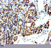 Immunohistochemical staining of SPOCK1 using anti-SPOCK1 antibody. SPOCK1 was detected in a paraffin-embedded section of human thyroid cancer tissue. Heat mediated antigen retrieval was performed in EDTA buffer (pH 8.0, epitope retrieval solution). The tissue section was blocked with 10% goat serum. The tissue section was then incubated with 2 ug/ml rabbit anti-SPOCK1 antibody overnight at 4oC. Peroxidase Conjugated Goat Anti-rabbit IgG was used as secondary antibody and incubated for 30 minutes at 37oC. The tissue section was developed using an HRP secondary and DAB substrate.