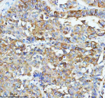 Immunohistochemical staining of GIPC1 using anti-GIPC1 antibody. GIPC1 was detected in a paraffin-embedded section of human liver cancer tissue. Heat mediated antigen retrieval was performed in EDTA buffer (pH 8.0, epitope retrieval solution). The tissue section was blocked with 10% goat serum. The tissue section was then incubated with 2 ug/ml rabbit anti-GIPC1 antibody overnight at 4oC. Peroxidase Conjugated Goat Anti-rabbit IgG was used as secondary antibody and incubated for 30 minutes at 37oC. The tissue section was developed using an HRP secondary and DAB substrate.