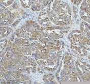 Immunohistochemical staining of GIPC1 using anti-GIPC1 antibody. GIPC1 was detected in a paraffin-embedded section of human liver cancer tissue. Heat mediated antigen retrieval was performed in EDTA buffer (pH 8.0, epitope retrieval solution). The tissue section was blocked with 10% goat serum. The tissue section was then incubated with 2 ug/ml rabbit anti-GIPC1 antibody overnight at 4oC. Peroxidase Conjugated Goat Anti-rabbit IgG was used as secondary antibody and incubated for 30 minutes at 37oC. The tissue section was developed using an HRP secondary and DAB substrate.