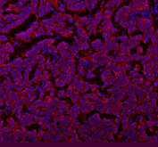 Immunofluorescent staining of SLC7A7 using anti-SLC7A7 antibody (red). SLC7A7 was detected in a paraffin-embedded section of human ovarian cancer tissue. Heat mediated antigen retrieval was performed in EDTA buffer (pH 8.0, epitope retrieval solution). The tissue section was blocked with 10% goat serum. The tissue section was then incubated with 5 ug/ml rabbit anti-SLC7A7 antibody overnight at 4oC. DyLight 594 Conjugated Goat Anti-Rabbit IgG was used as secondary antibody at 1:500 dilution and incubated for 30 minutes at 37oC. The section was counterstained with DAPI nuclear stain (blue). Visualize using a fluorescence microscope and filter sets appropriate for the label used.
