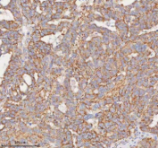Immunohistochemical staining of SLC7A7 using anti-SLC7A7 antibody. SLC7A7 was detected in a paraffin-embedded section of human ovarian cancer tissue. Heat mediated antigen retrieval was performed in EDTA buffer (pH 8.0, epitope retrieval solution). The tissue section was blocked with 10% goat serum. The tissue section was then incubated with 2 ug/ml rabbit anti-SLC7A7 antibody overnight at 4oC. Peroxidase Conjugated Goat Anti-rabbit IgG was used as secondary antibody and incubated for 30 minutes at 37oC. The tissue section was developed using an HRP secondary and DAB substrate.