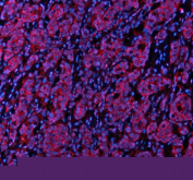 Immunofluorescent staining of STXBP3 using anti-STXBP3 antibody (red). STXBP3 was detected in a paraffin-embedded section of human breast cancer tissue. Heat mediated antigen retrieval was performed in EDTA buffer (pH 8.0, epitope retrieval solution). The tissue section was blocked with 10% goat serum. The tissue section was then incubated with 5 ug/ml rabbit anti-STXBP3 antibody overnight at 4oC. Cy3 Conjugated Goat Anti-Rabbit IgG was used as secondary antibody at 1:500 dilution and incubated for 30 minutes at 37oC. The section was counterstained with DAPI nuclear stain (blue). Visualize using a fluorescence microscope and filter sets appropriate for the label used.
